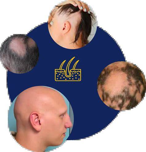 Androgenes alopecia vizuális ismertető