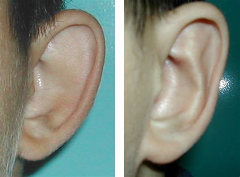 fülplasztika előtt és után