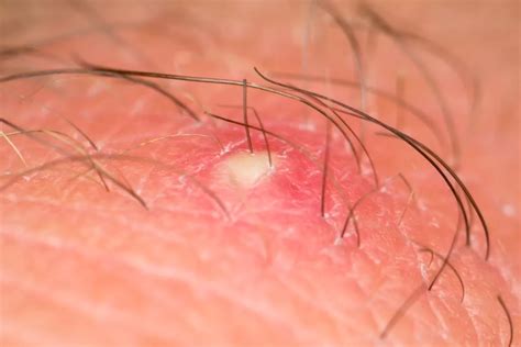 Szemléltető ábra a szőrtüsző anatómiájáról és a gyulladás folyamatáról