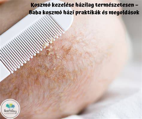 Baba fejbőrén koszmó kezelése