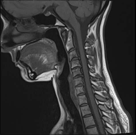 nyaki gerinc MRI kép