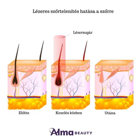 Lézeres szőrtelenítés és eflornitin krém kombinációja
