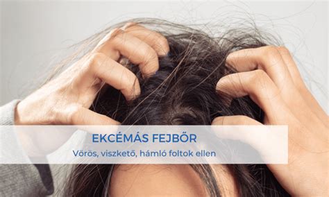 A fejbőr problémáinak illusztrációja