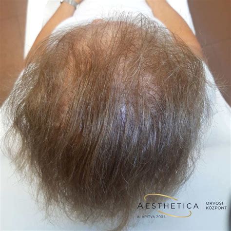 Férfias típusú hajhullás mintázata