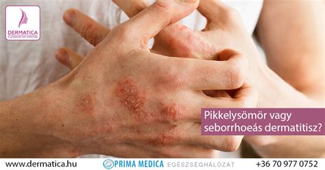 Pikkelysömör és seborrheás dermatitisz a fejbőrön