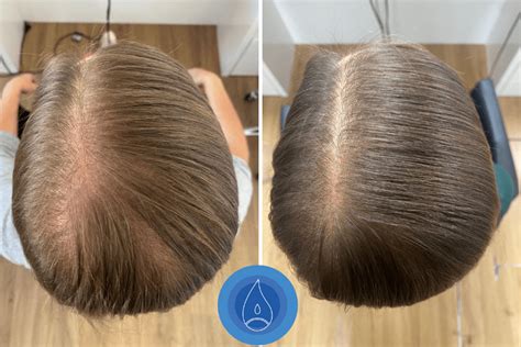 Hormonális változások és a hajhullás kapcsolata