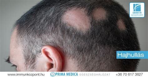 A foltos hajhullás (alopecia areata) képekben