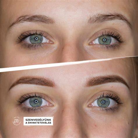 szemoldok tetovalas utana botox kulso hatasok