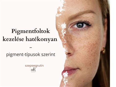 Anyajegyek és pigmentfoltok kezelése IPL előtt