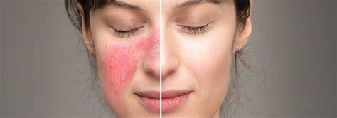 Infografika: rosacea típusai és kiváltó tényezők