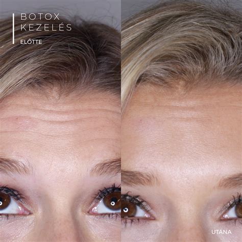 Haj Botox kezelés eredménye