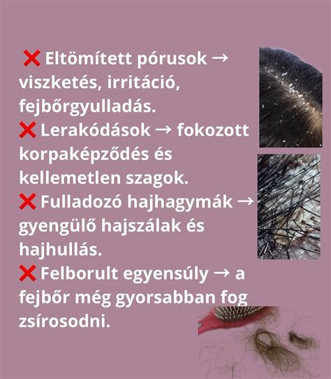 A fejbőr mikroszkópos képe, ahol láthatóak a hajhagymák és a hajszálak.