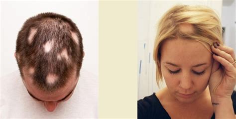 A hajhullás különböző típusainak illusztrációja: diffúz, foltos és kopaszodó területek.