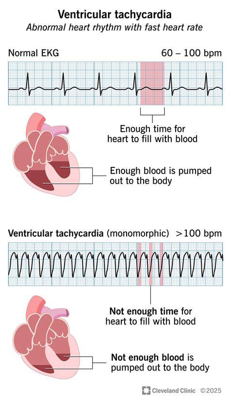 infografika a tachycardia típusairól
