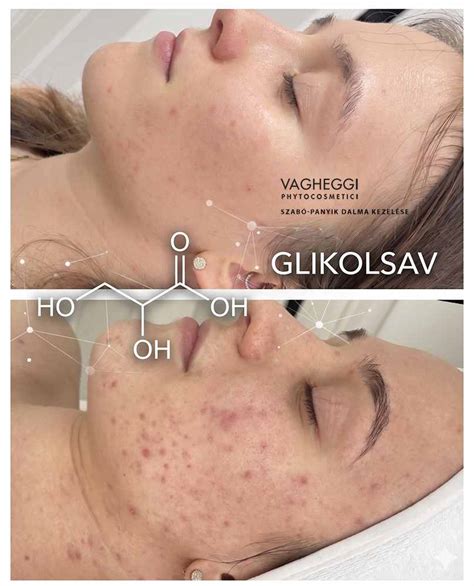 Ionoforézis és mikrodermabrázió hatása a bőrre