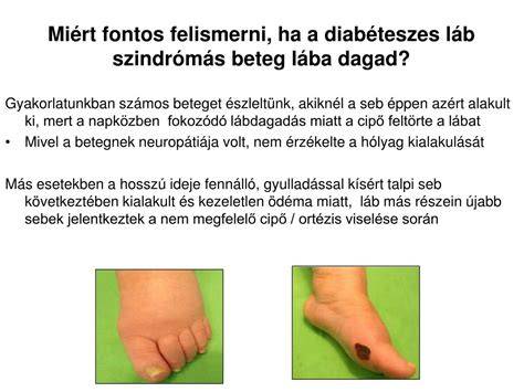 Diabéteszes láb megelőzése és kezelésének ábrája