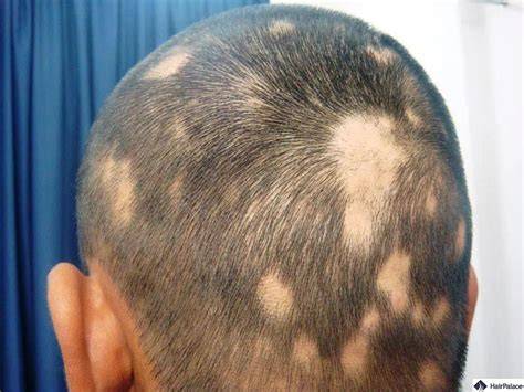 Alopecia areata által érintett fejbőr és köröm elváltozások