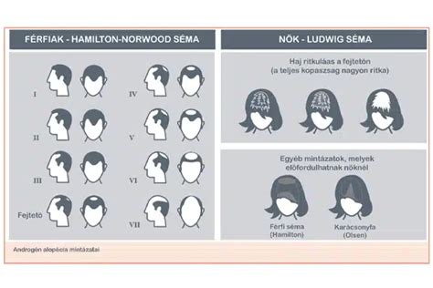 Hajhullás okai és típusai