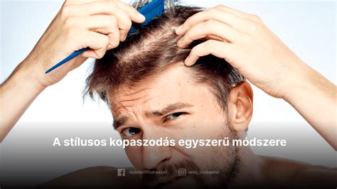 A férfi kopaszodás mintázata