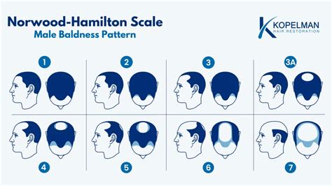 A Norwood-Hamilton skála a kopaszodás mértékének meghatározására