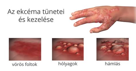 Az ekcéma tünetei: kipirosodott, viszkető bőr
