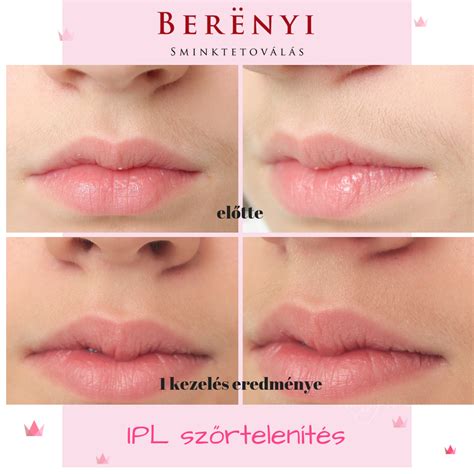 IPL szőrtelenítés különböző testrészeken