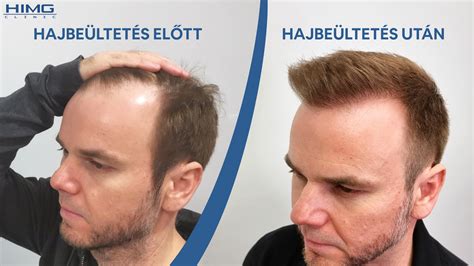 Hajbeültetés utáni regeneráció és sportolás