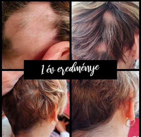 illusztráció a hajhullás különböző típusairól