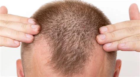 A hajhullás mintázata férfiaknál és nőknél