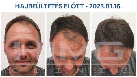 hajbeültetés folyamat ábrázolás infographic