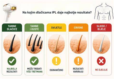 Infografika az IPL működéséről és a Lumea előnyeiről