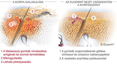 Infografika: Korpásodás elleni samponok hatóanyagok szerint