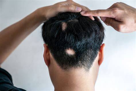 Infografika: Alopecia areata okai, formái és kezelésének leírása