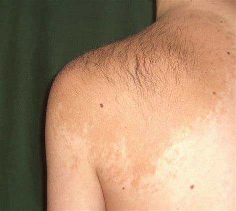 Becker nevus fotó jellegzetességekkel
