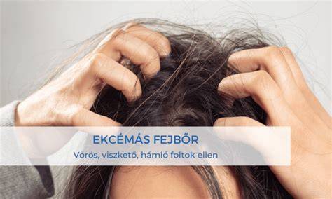 ekcéma fejbőrön vörös hámló foltok