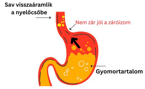 gyomor röntgenfelvétele hajgombóccal
