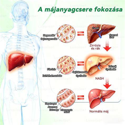 Abetalipoproteinemia és kapcsolódó zsíranyagcsere-kórképek vizualizációja