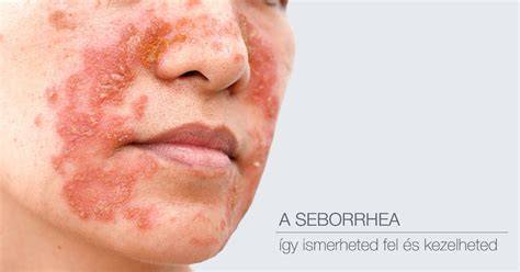 Infografika: A seborrheás dermatitisz okai és tünetei