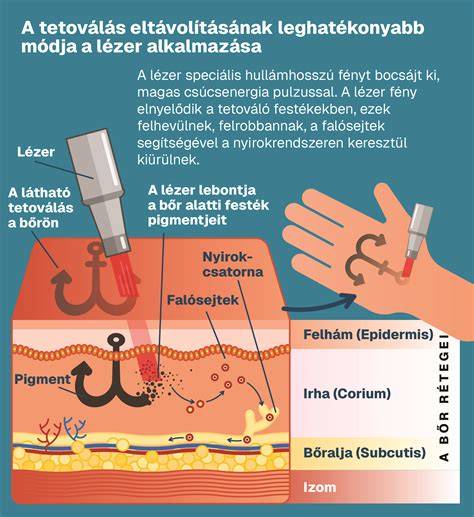 Infografika a lézeres tetoválás eltávolításról