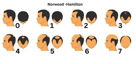 Norwood IV-V területek fedésének becslése