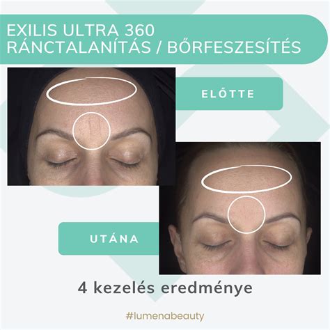 arc spa-spiralás és kefék ábrája