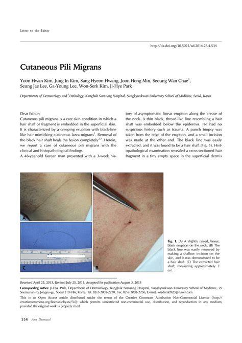 Infografika: Cutaneous Pili Migrans és a talpi hajbehatolás