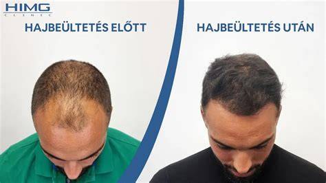 hajbeültetés előtti-fejbőr előkészítés