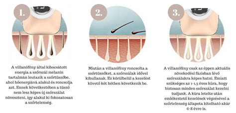 Infografika: otthoni intim szőrtelenítés lépései