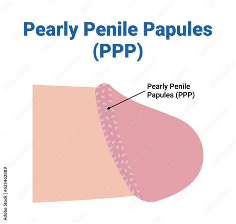 Illusztráció: Pearly penile papules és Fordyce-foltok a nemi szervek környékén