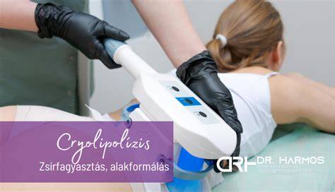 zsírfagyasztás vizuális áttekintése