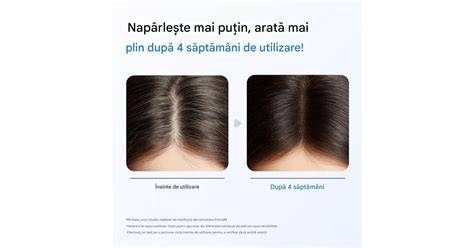 Diagram: férfiak körében a korpásodás és hajhullás előfordulása
