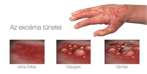 fejbőr ekcéma tünetei vörös hámlás