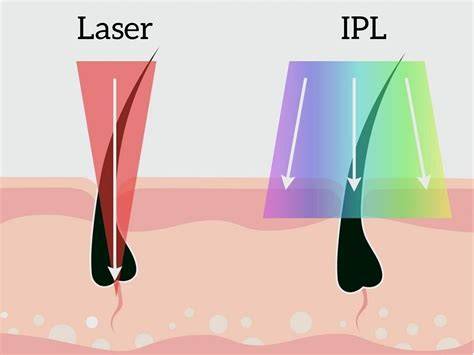 IPL vs laser playground infographic