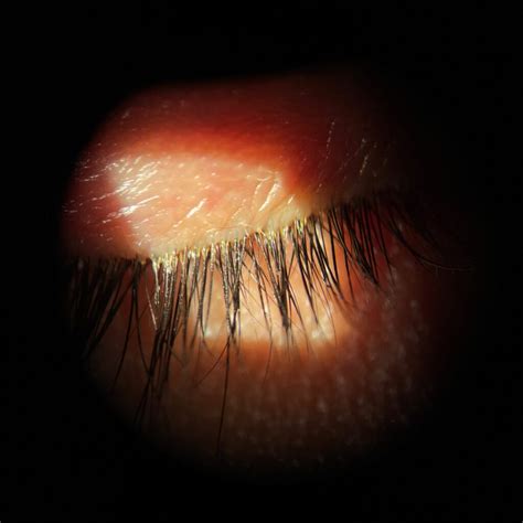 kép a blepharitis tüneteiről